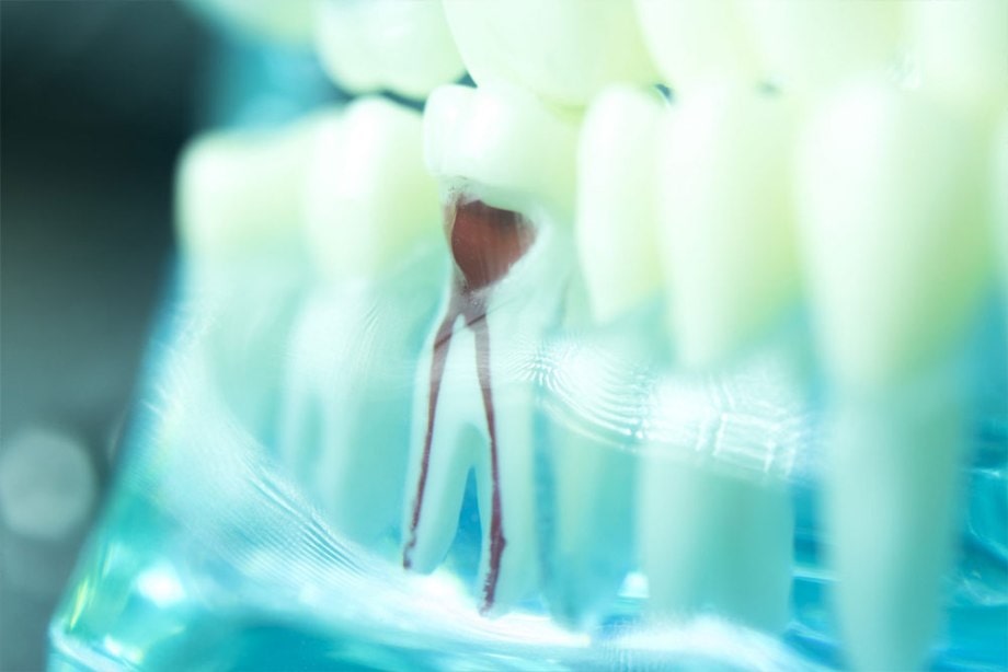6 Most Popular Root Canal FAQs & Dental Crowns Encinitas