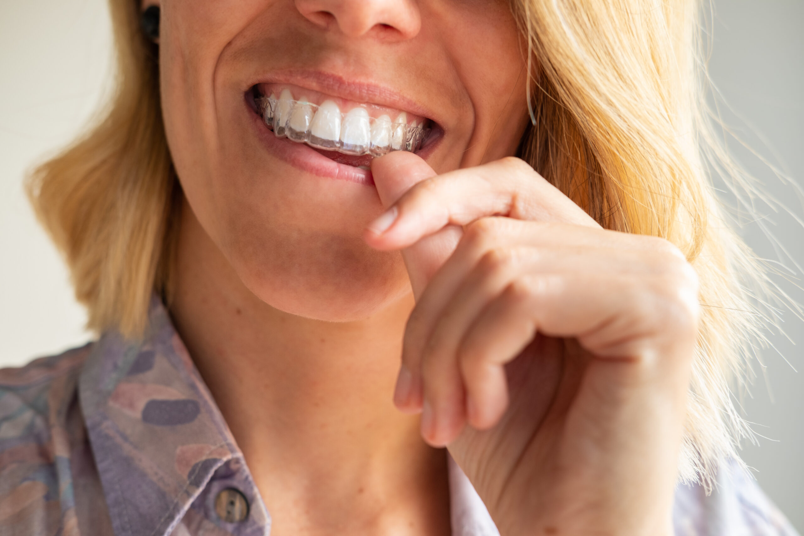 Clear Braces vs. Traditional Braces: Which is Right for You?