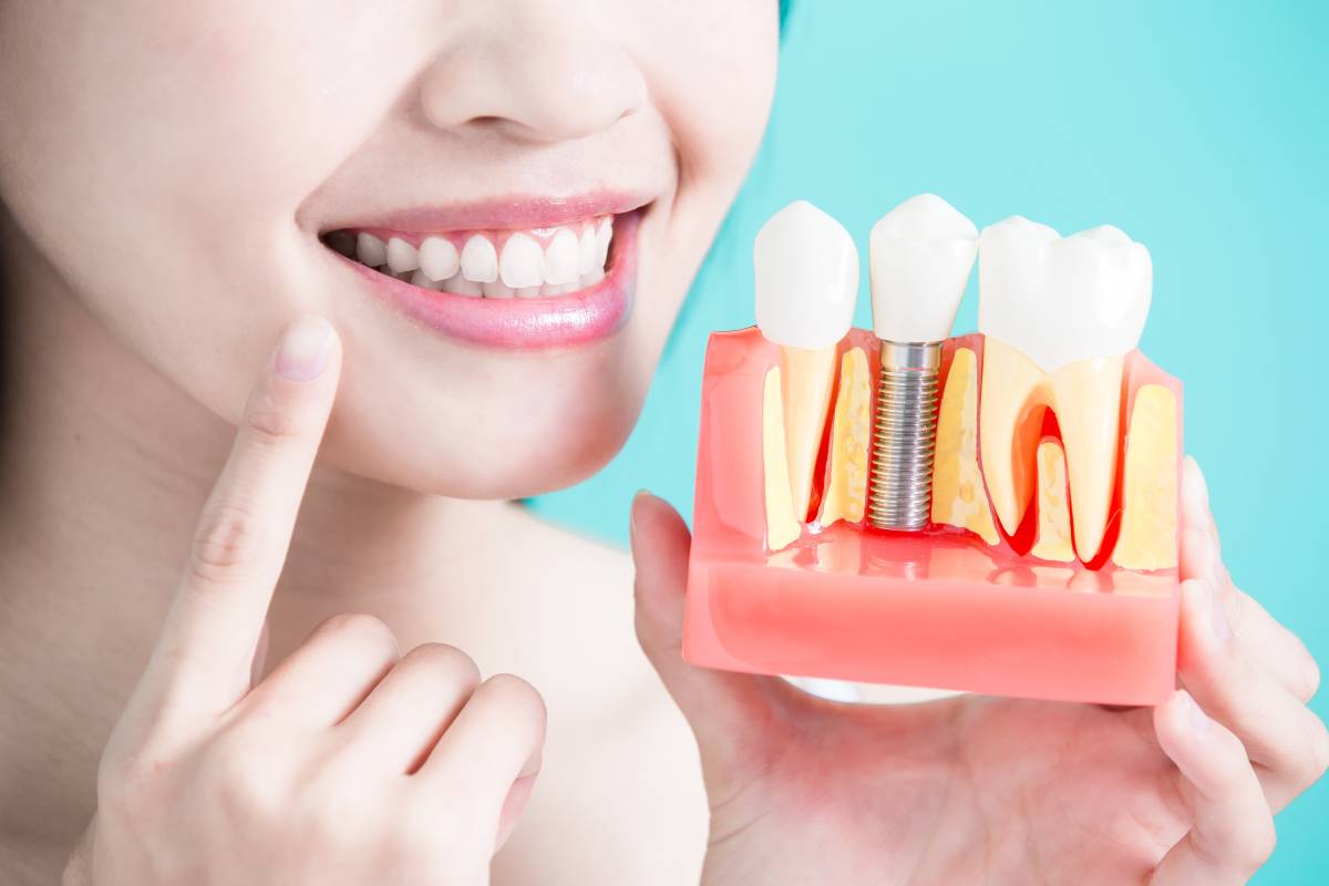 Dental Implant After Care