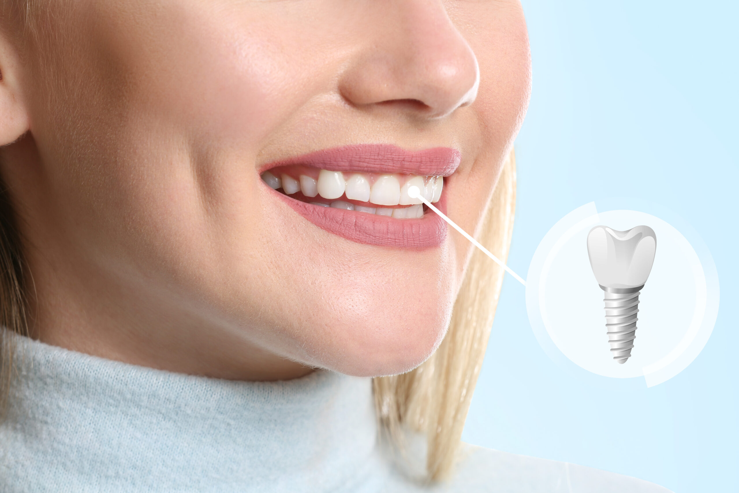 The Benefits and Process of Dental Implants: A Comprehensive Guide