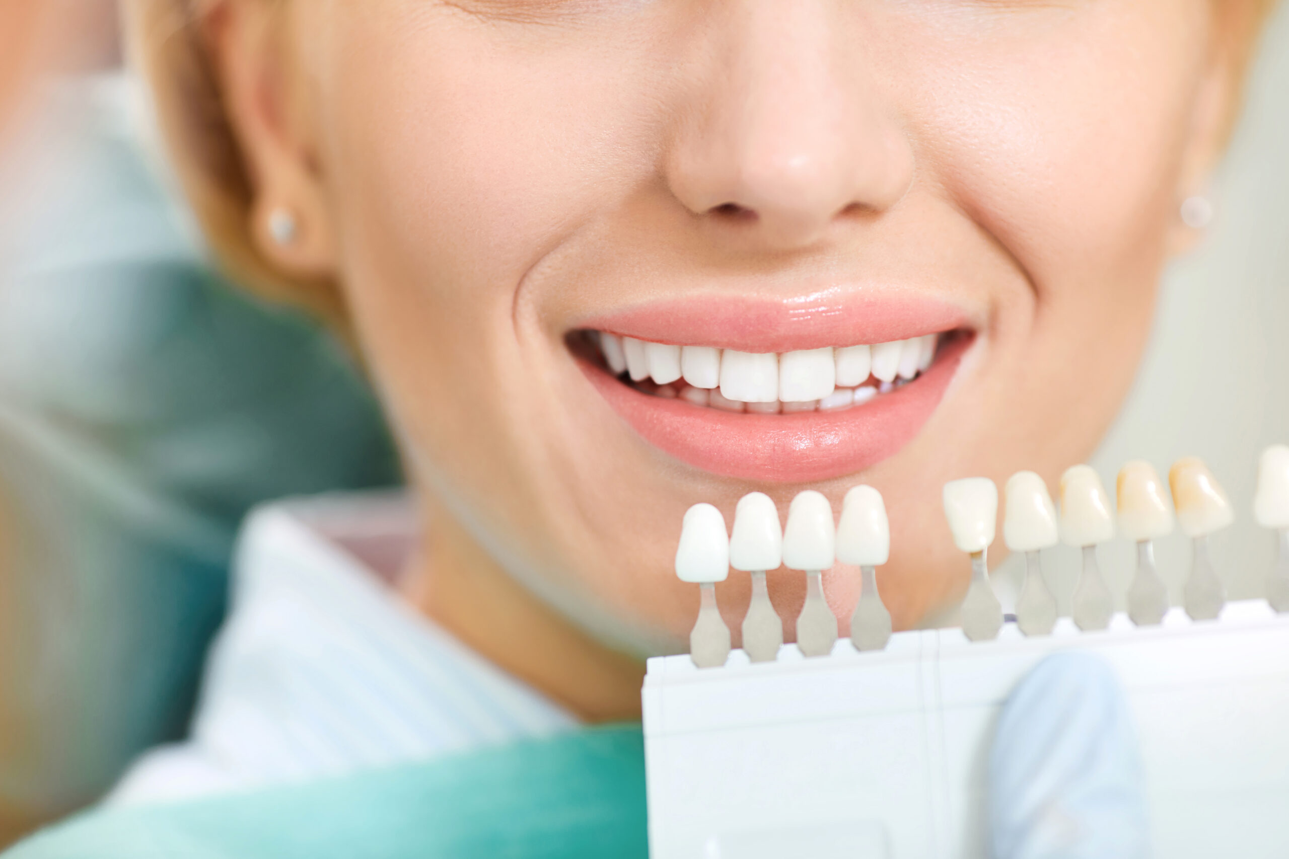 Home Teeth Whitening Kits vs. Professional Treatments in Encinitas: Pros and Cons