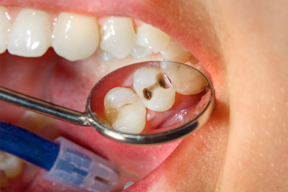 Gingivitis vs. Periodontitis: What’s the Difference?