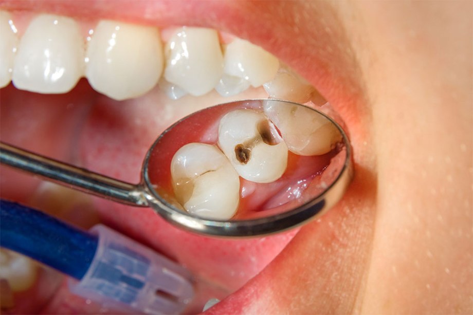 What Is Dental Plaque - Bacterial Plaque, Tartar, Gingivitis, Gum Disease